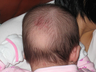 eleanor's bald patch